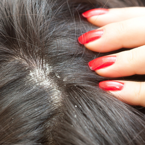 importante traqueteo Destruir Cómo eliminar la caspa: la guía definitiva para un cuero cabelludo sano