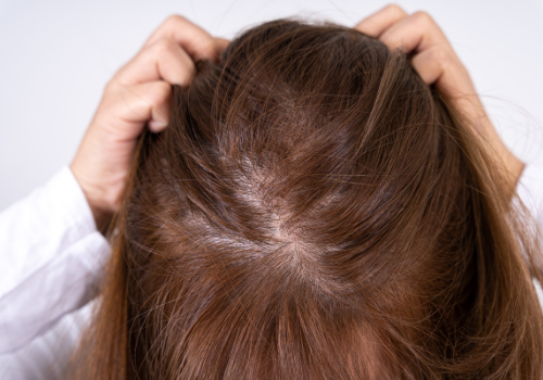 problemas capilares en cabellos finos por falta de protección solar