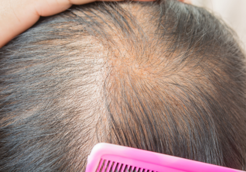 Problemas capilares en cabellos escasos