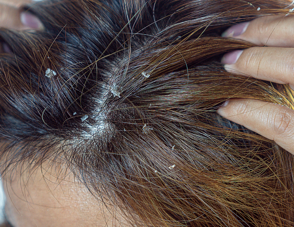 Exceso de caspa, una de las anomalías más comunes por la sequedad del cuero cabelludo.